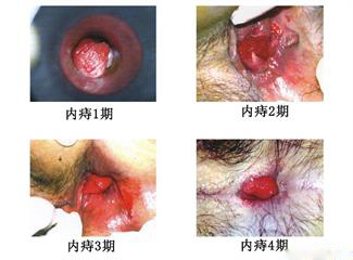 内痔各期情况.jpg