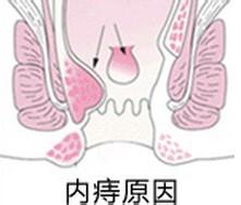 内痔原因