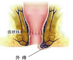 外痔2 外痔2