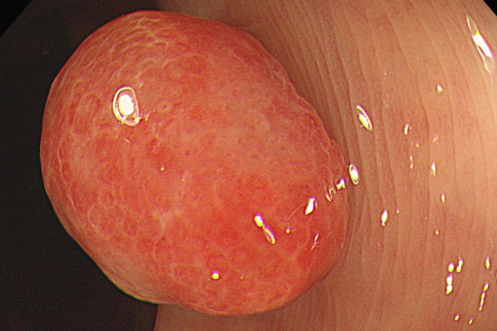 直肠息肉 直肠息肉