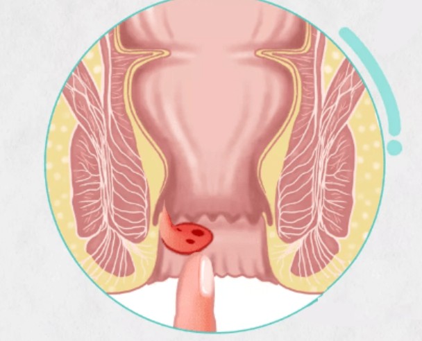 外痔.jpeg 外痔.jpeg