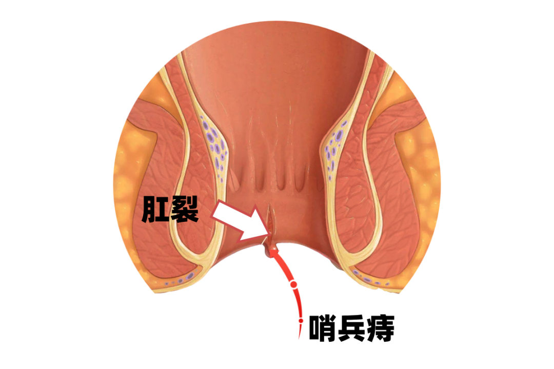 肛裂.png