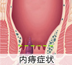 内痔疮症状