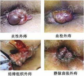 外痔1