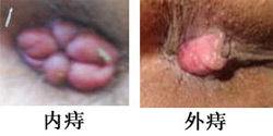 内痔外痔 内痔外痔