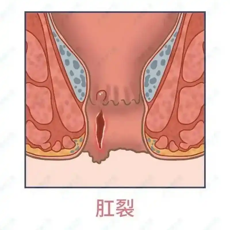 肛裂1