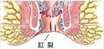 肛裂22