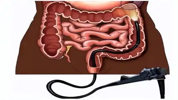 肠镜检查 肠镜检查