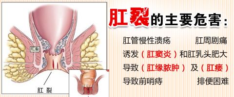 肛裂的危害